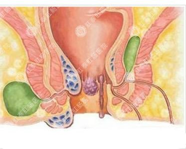 南寧哪個醫(yī)院可以做肛周膿腫？
